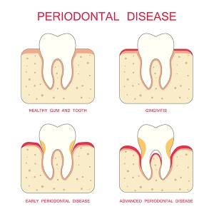 periodontal therapy aurora
